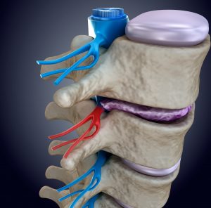 Spinal nerve compressed by bulging disc