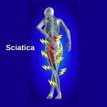 Areas of pain affected by sciatica